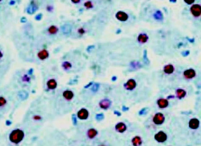 Hepatitis B Core (HBc) IgG