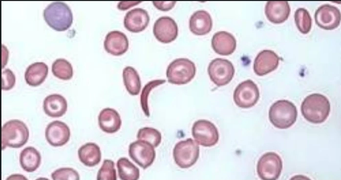 Sickle Cell Screen Test