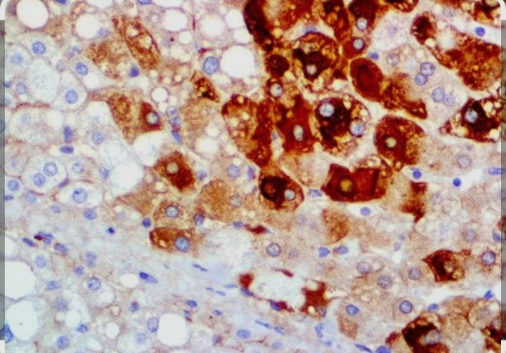 Hepatitis B Surface Abs (HBs Abs)