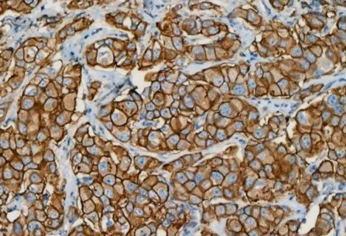 Immunohistochemistry: Her-2