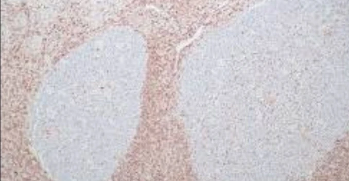 Immunohistochemistry: BCL2