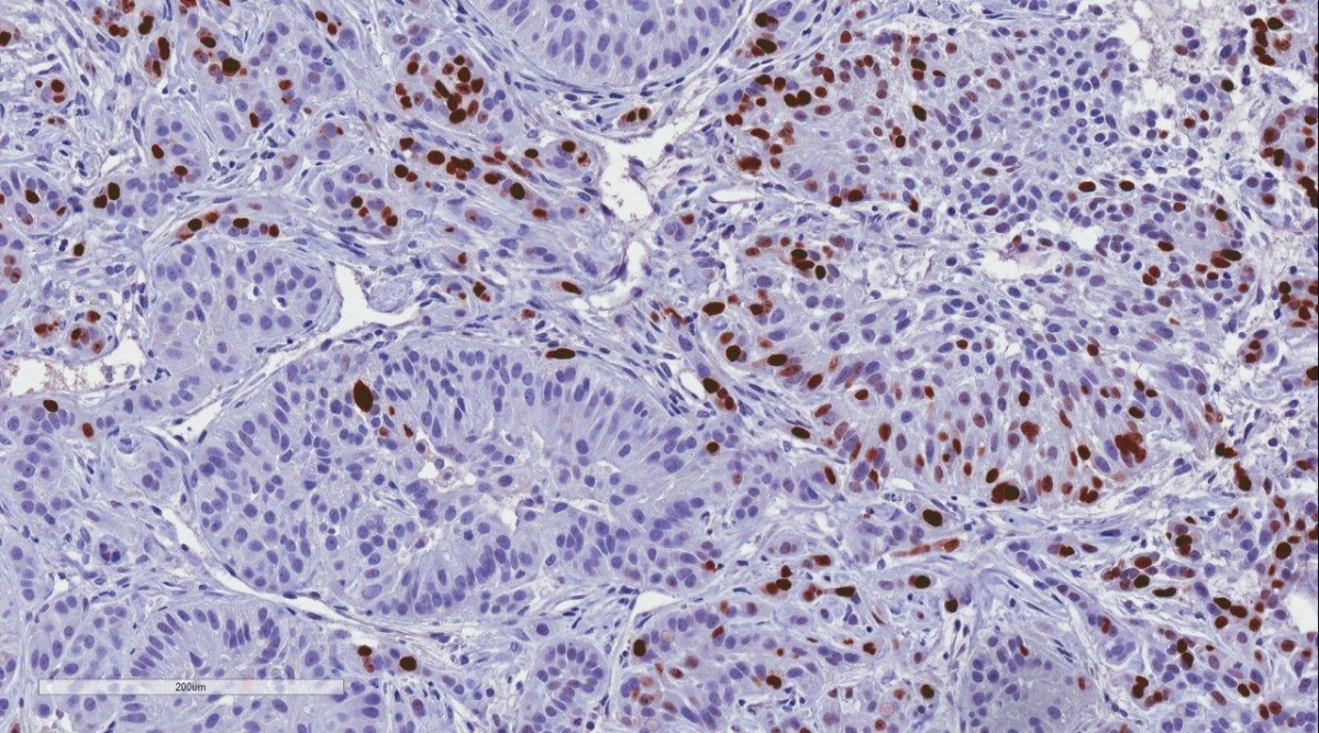 Immunohistochemistry:KI67