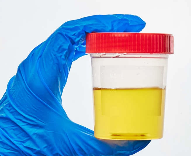 zinc Urine