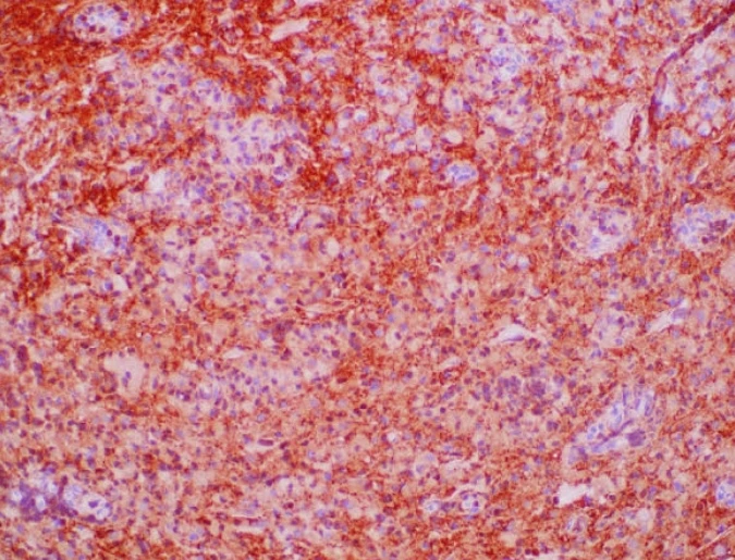 Immunohistochemistry: S100