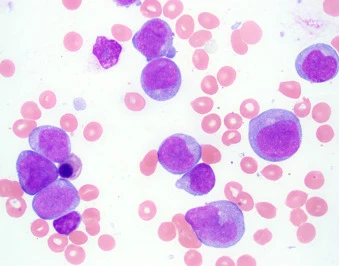 Leukemia/ Lymphoma Phenotyping, Comprehensive Acute Chronic Panel