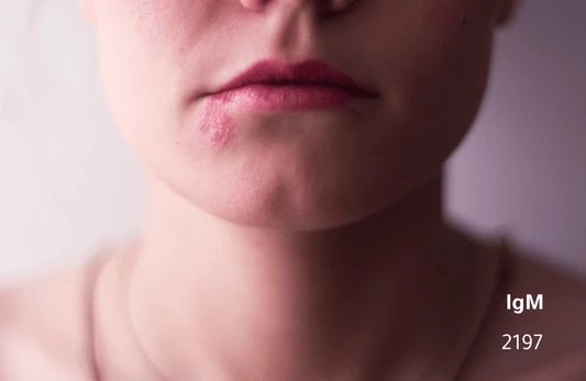 فيروس الهربس (HSV) 2 IgM