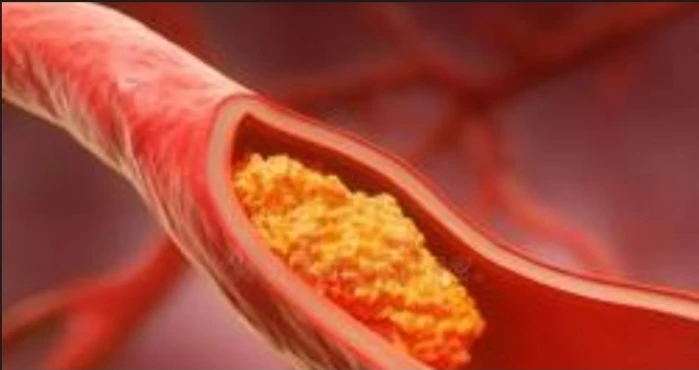 Low Density Lipoprotein (LDL)