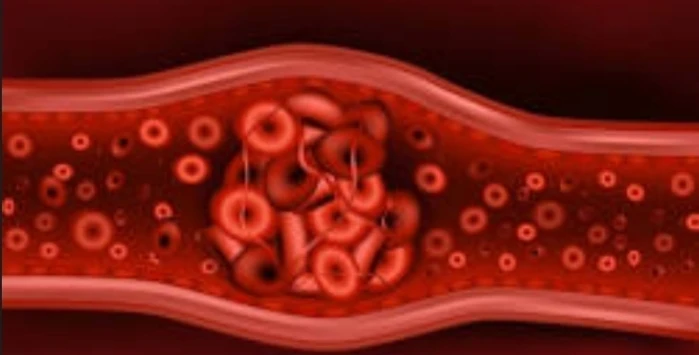 Tissue plasminogen activator (TPA)