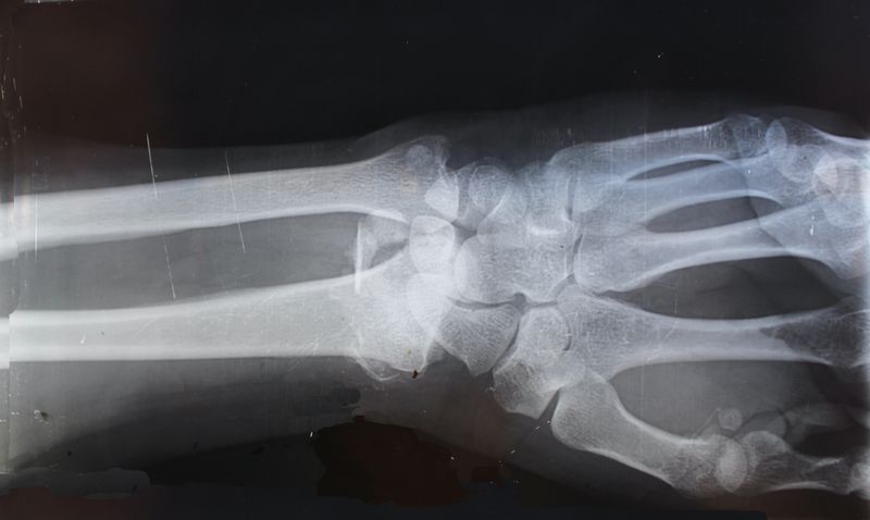 An X-Ray scan on a person's wrist.