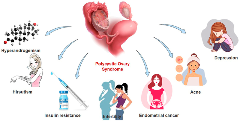 Illustration of a polycystic ovary with arrows pointing to symptoms like insulin resistance, infertility, acne, etc.