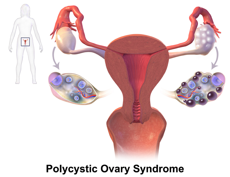 Illustration of the uterus and ovaries. Left side showing a normal ovary while the right shows multiple cysts in the ovary.