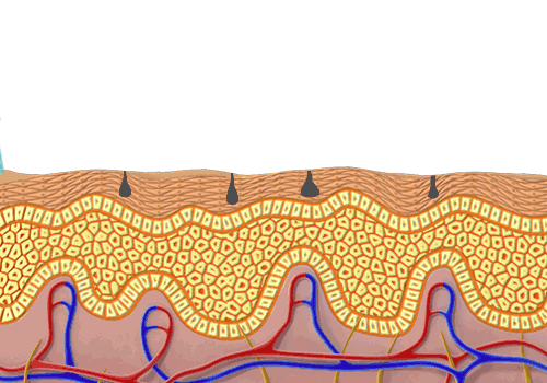 A microderm needle moving along a cross-section of skin