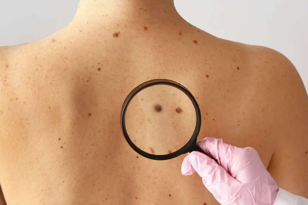 Alerta en la piel: Por qué identificar al "patito feo" puede salvarte la vida