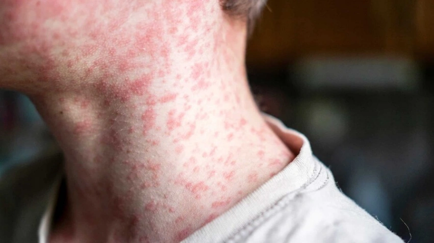 Pensilvania confirma cuarta muerte por sarampión en la peor epidemia de EE. UU. en 35 años