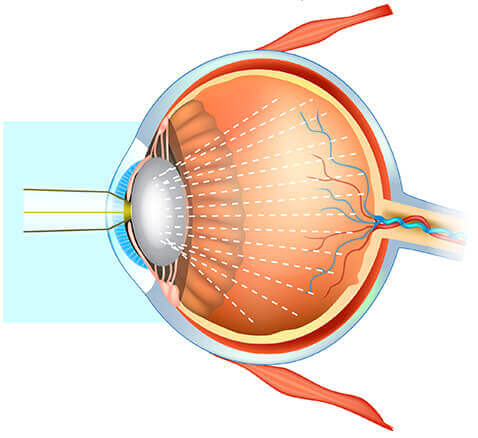 Cataracts