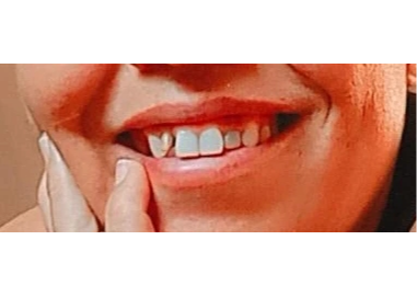 Banner Tratamento dentário de perda óssea 