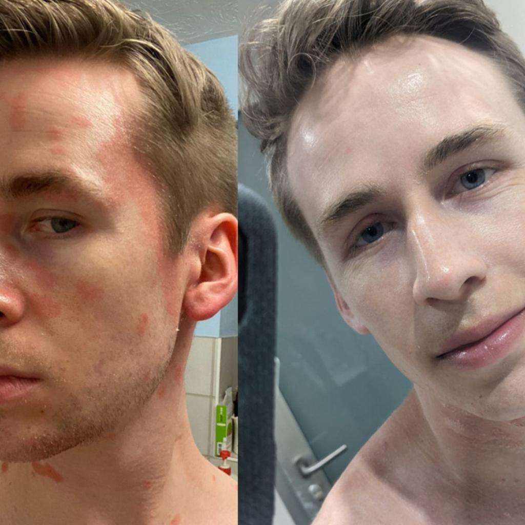 Young man's life transformed after breakthrough eczema treatment with dupilumab - Ballarat, VIC