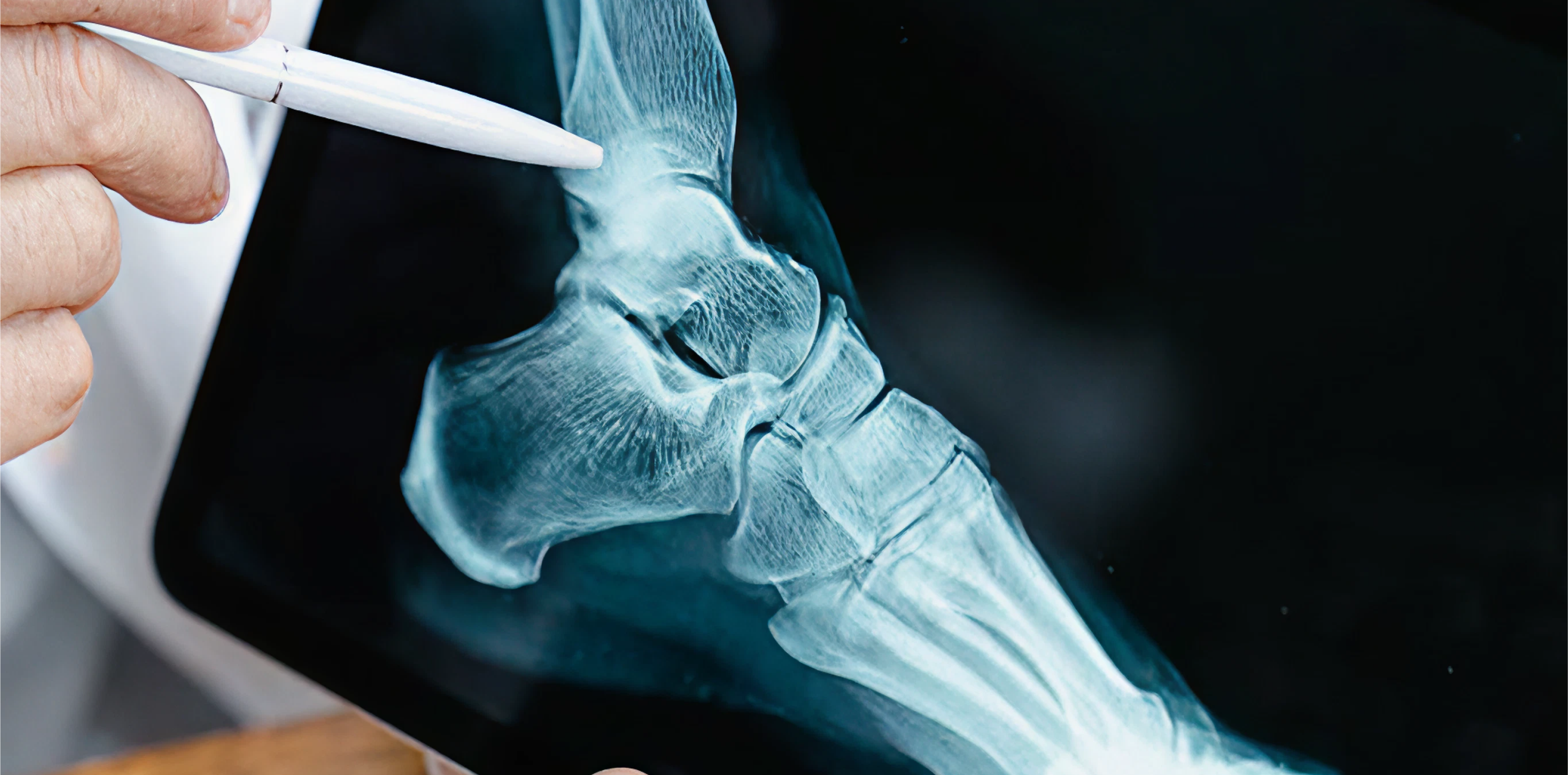 Boosting Bone Health