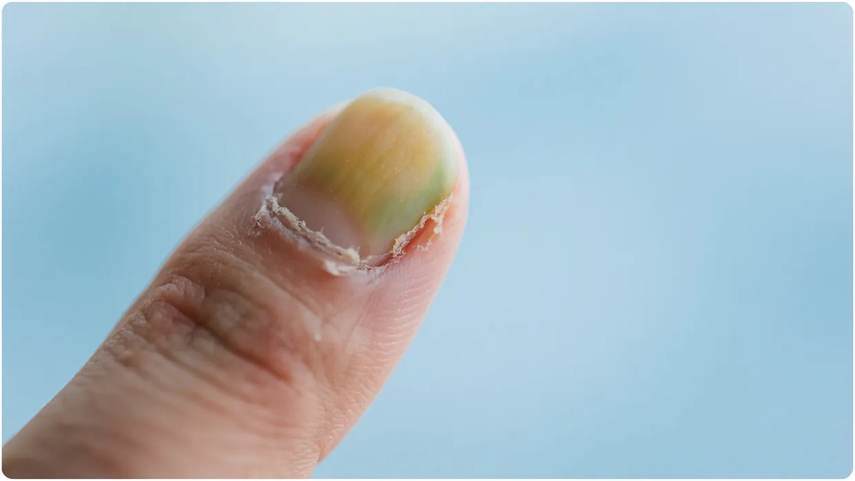 Repeatedly Break Nails? It could be a sign of Nutrient Deficiency, Here’s What You Need to Know