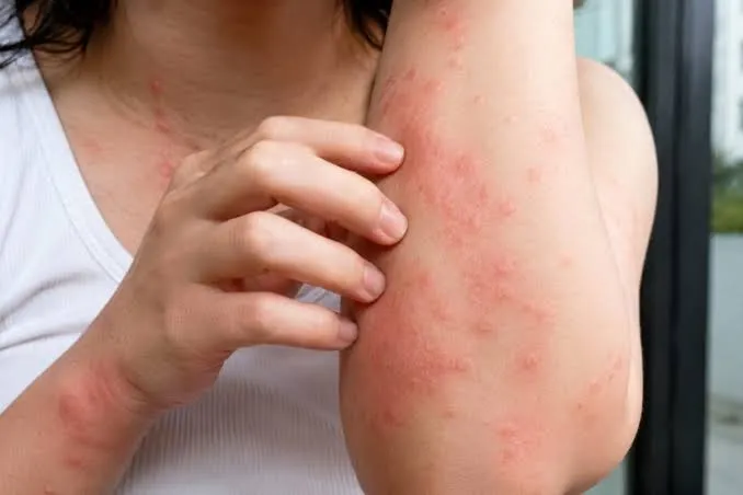Persistent Itching and Rashes? It Could Be CSU; Know the Symptoms and Risks