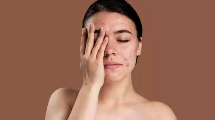 How To Ged Rid Of Chickenpox Scars; Daily Care Routine And Precautions