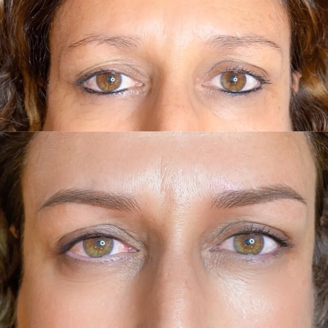 DERMOPIGMENTACION FACIAL: trabajo 1