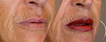 DERMOPIGMENTACION FACIAL: trabajo 5