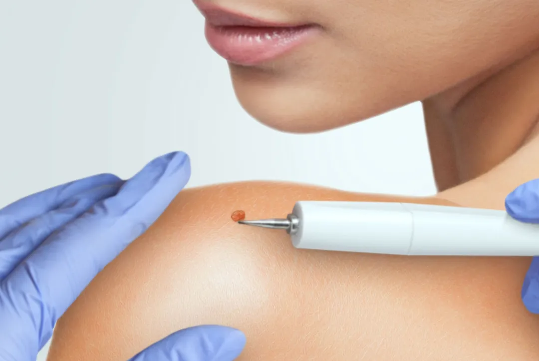 Fibroplas