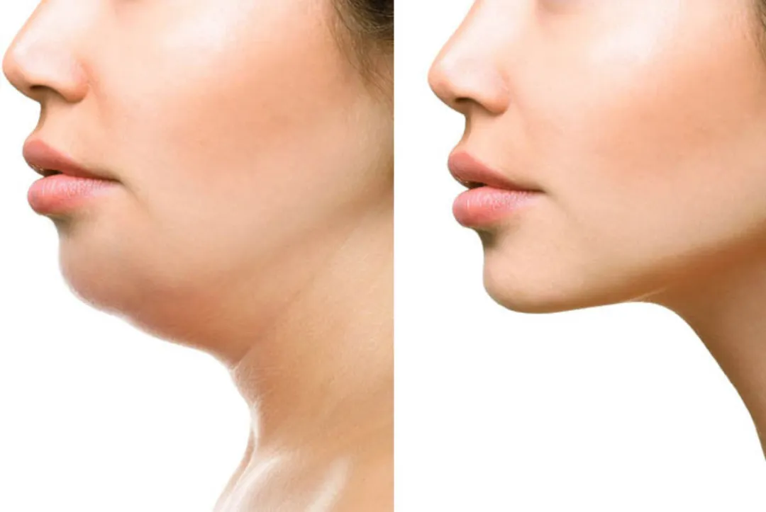 Liporemodelante facial