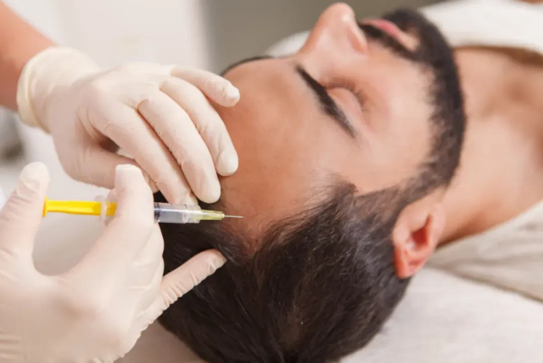 MESOTERAPIA CAPILAR