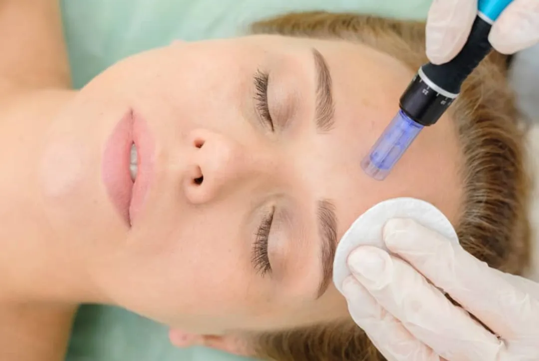 Micromesoterapia