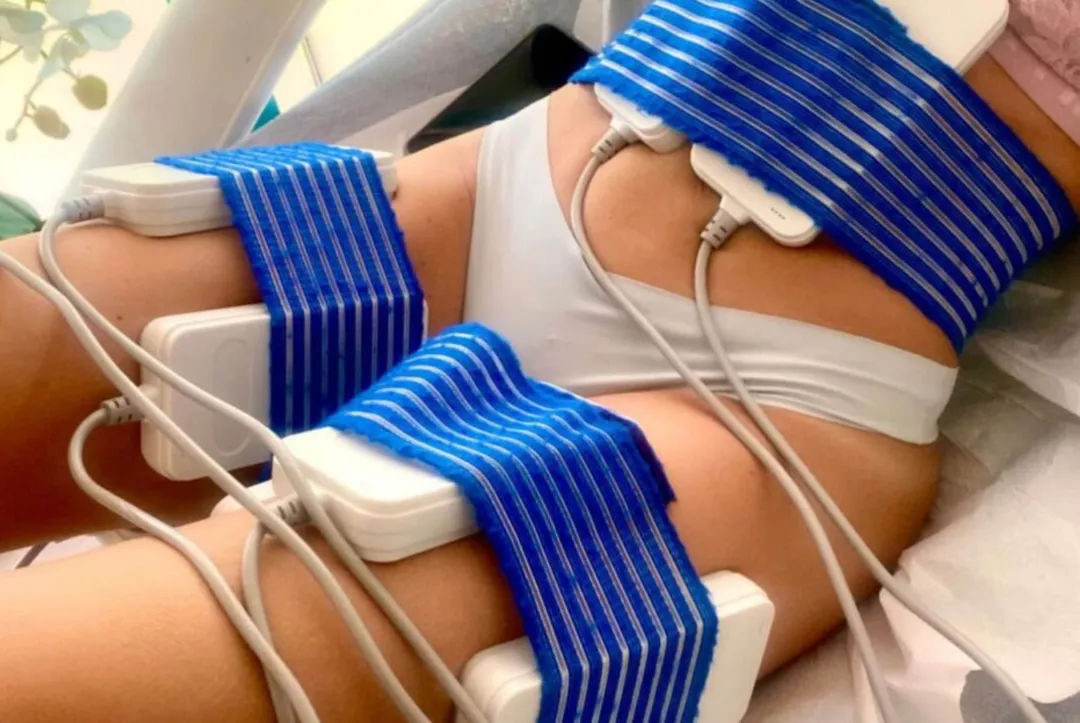 Termolipolisis Reductora