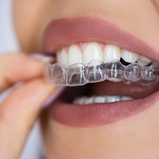 Invisalign