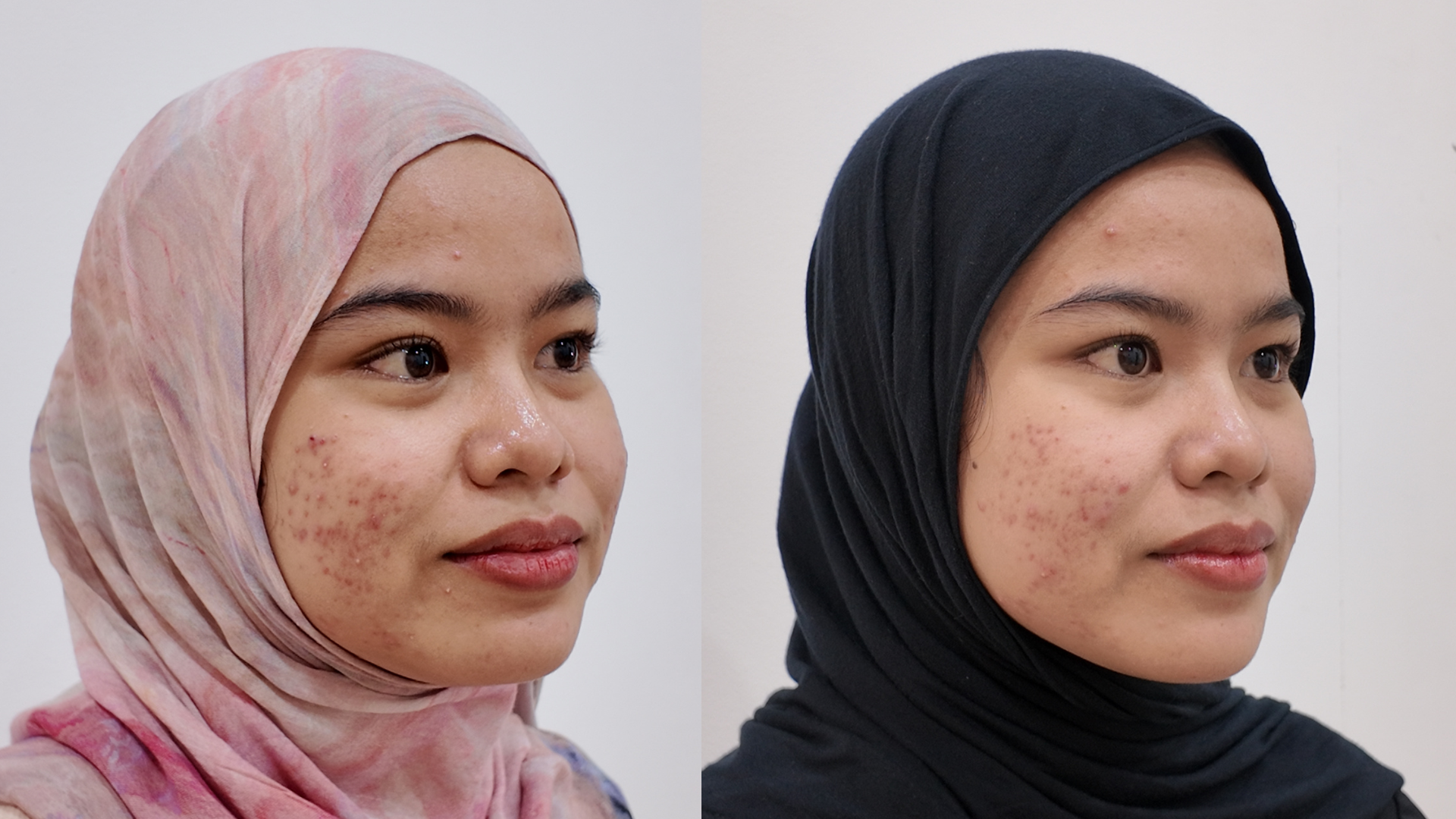 Hasil Pemantauan Medis Pemulihan Kulit 4 Minggu - Majestic Cosme