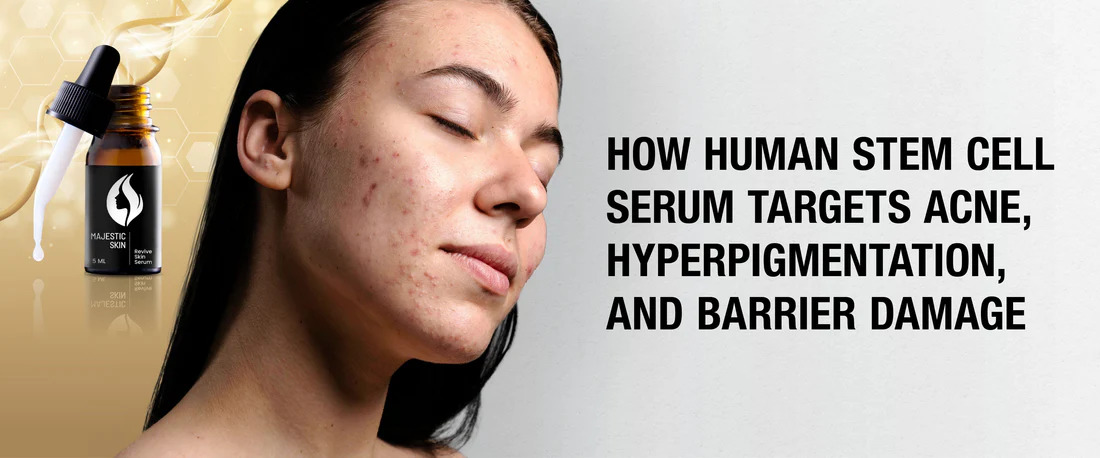How Human Stem Cell Serum Targets Acne, Hyperpigmentation, and Barrier Damage