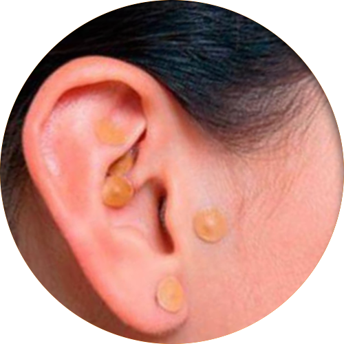 Auriculoterapia