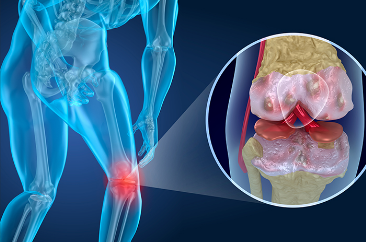 Imagen de portada para La artrosis