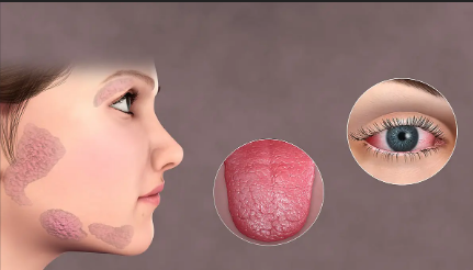 Imagen de portada para Síndrome de Sjögren