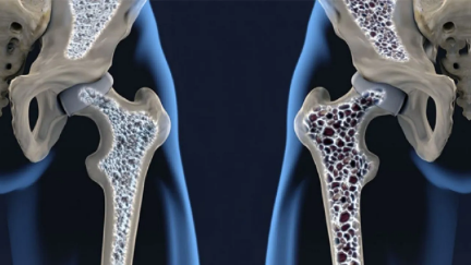 Imagen de portada para Osteoporosis