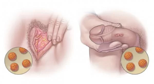 Genital Warts (Masundosundo): Tiba na jinsi ya kujikinga