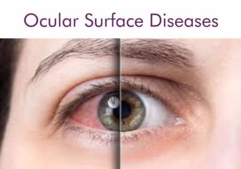 services/ocular_surface_diseases_management