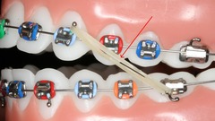 Orthodontic Instrument Review