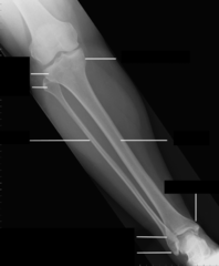 AP Tibia Fibula Comp Anatomy
