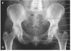 AP Pelvis X-Ray Anatomy