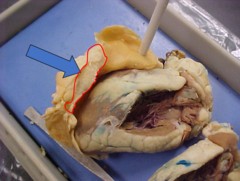 AP2 HEART ANATOMY