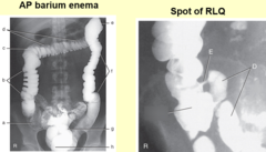 AP barium enema & RLQ (anatomy)