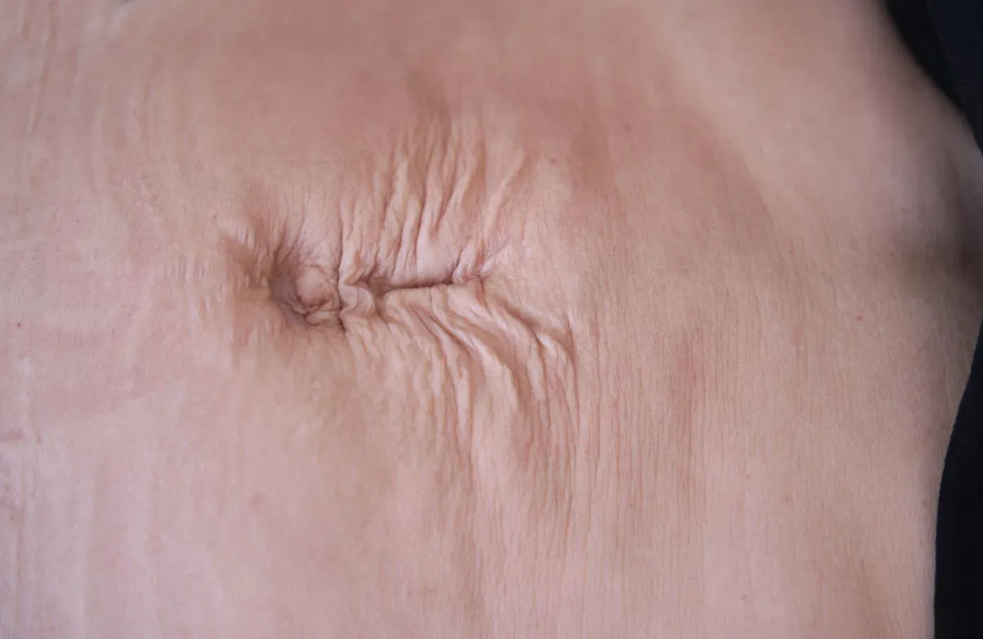 Imagen del curso: Tratamiento de la REPA y la Abdominoplastia desde la Fisioterapia y el Ejercicio
