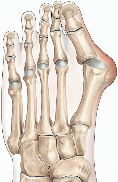 Bunion Treatment