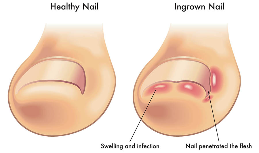 Ingrown Toenail Treatment