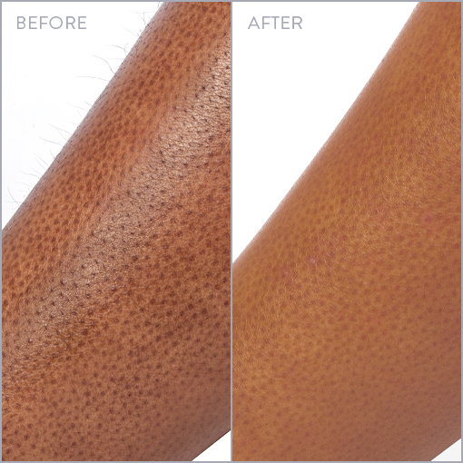 Legs Laser Hair Removal Photo, Before & After
